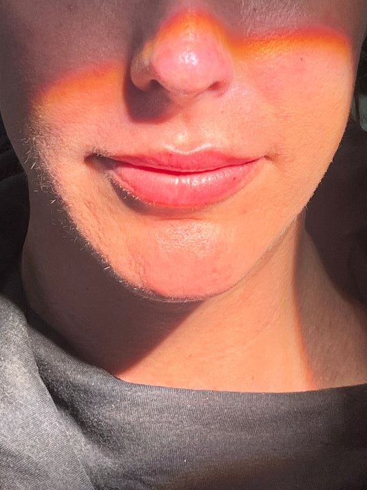 Can Lip filler ever look natural ? YES